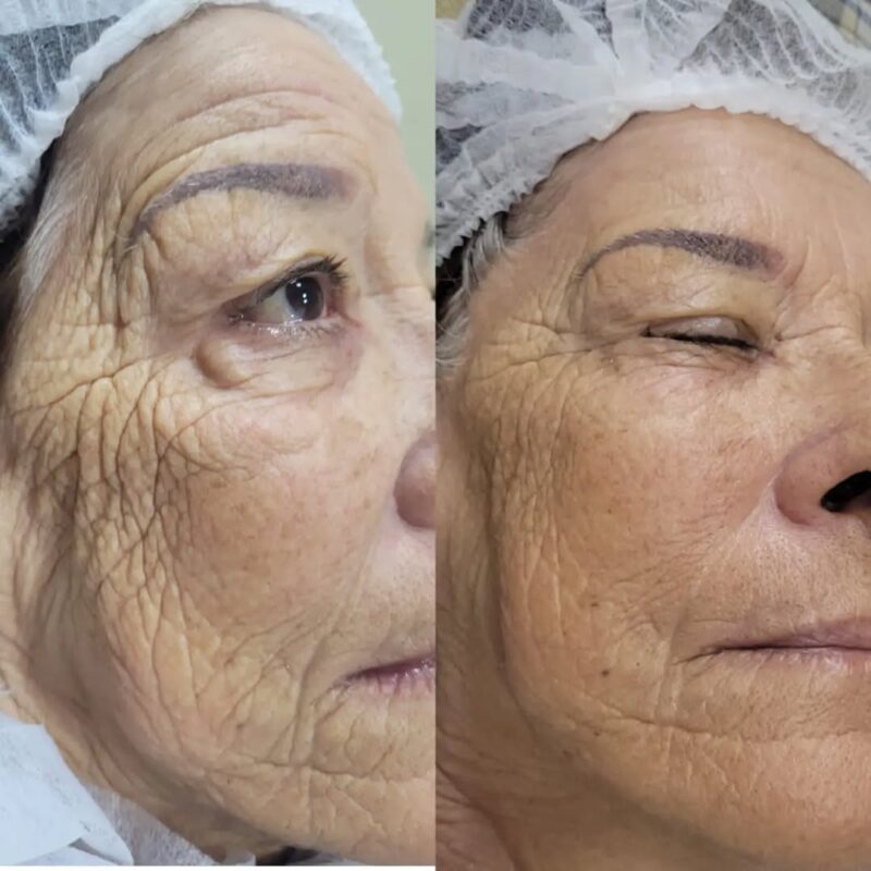 Antes e depois com Proxy Enzima